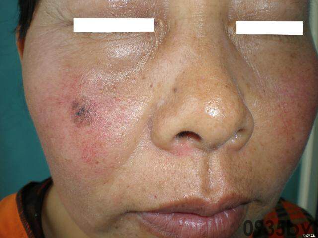 常见皮肤疾病典型图片汇总(图11)