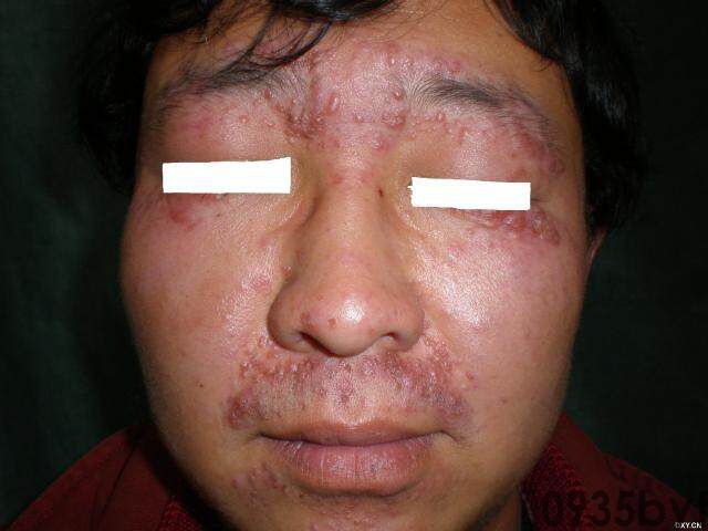 常见皮肤疾病典型图片汇总(图14)