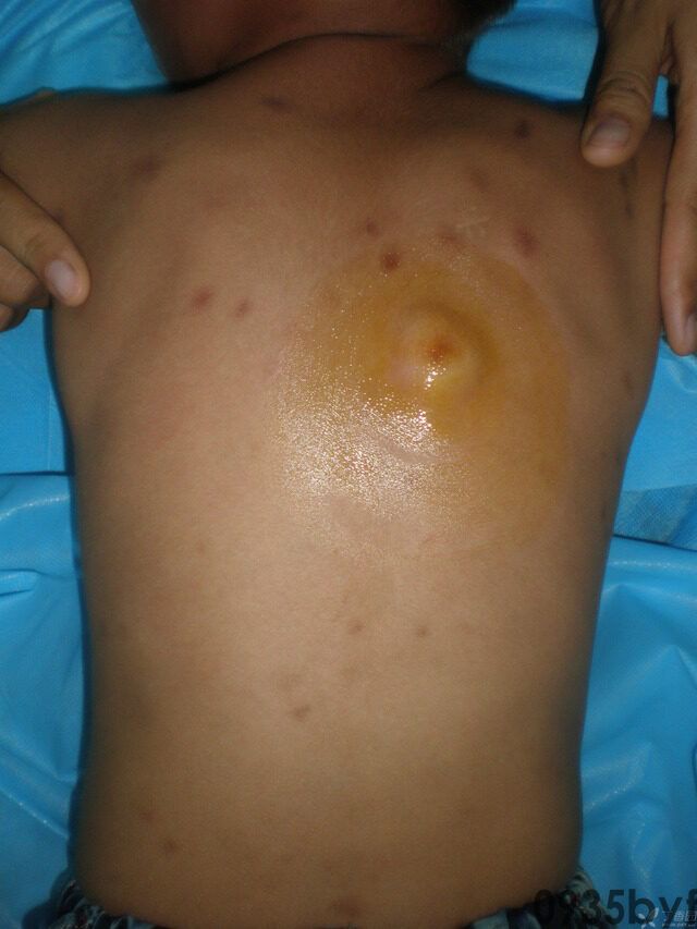 常见皮肤疾病典型图片汇总(图19)