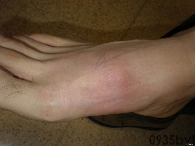 常见皮肤疾病典型图片汇总(图12)