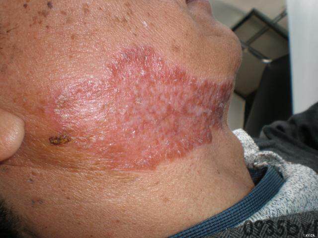 常见皮肤疾病典型图片汇总(图15)