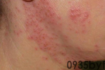 红斑是什么症状图片怎么治(图2)