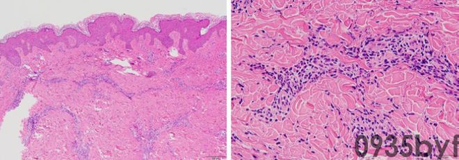 反复红斑10年会是什么病？看图诊断(图2)