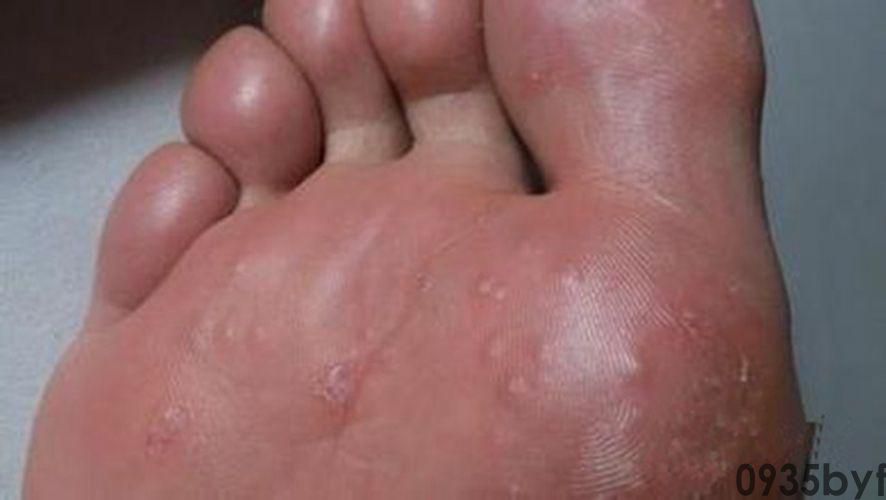 治水泡型脚气的药有哪些