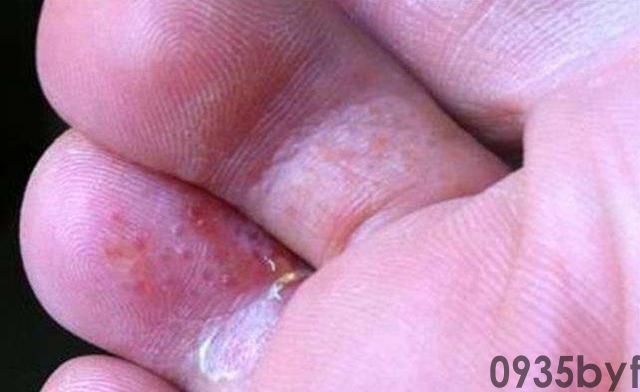 水泡脚气怎么治疗