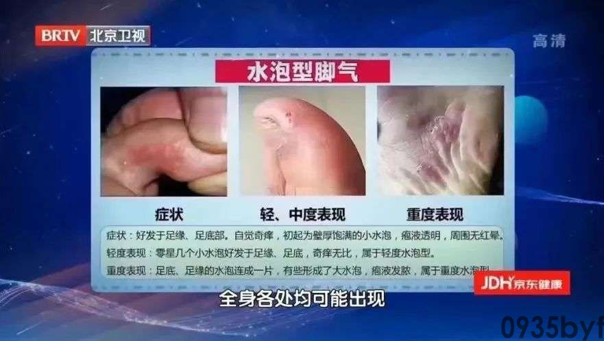 水泡型脚气的症状喂养不得当当心孩子患脚气