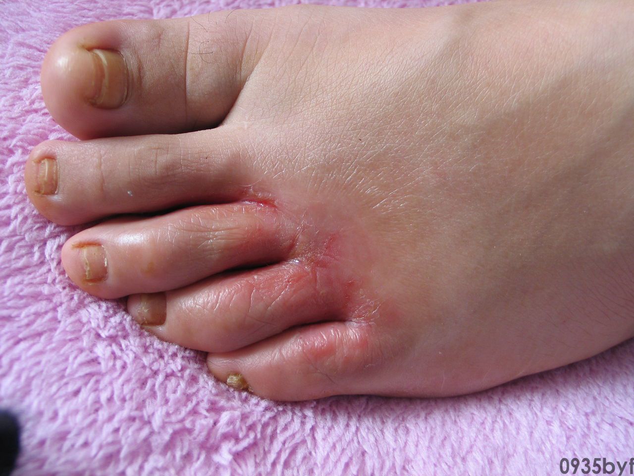 糜烂型脚气治疗方法(图1) 糜烂型脚气治疗方法