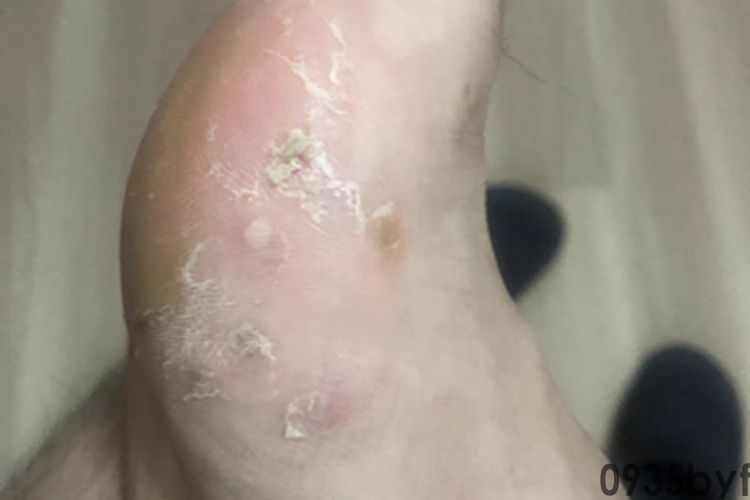 足癣脚部脱皮图片(图3) 足癣脚部脱皮图片(图3)