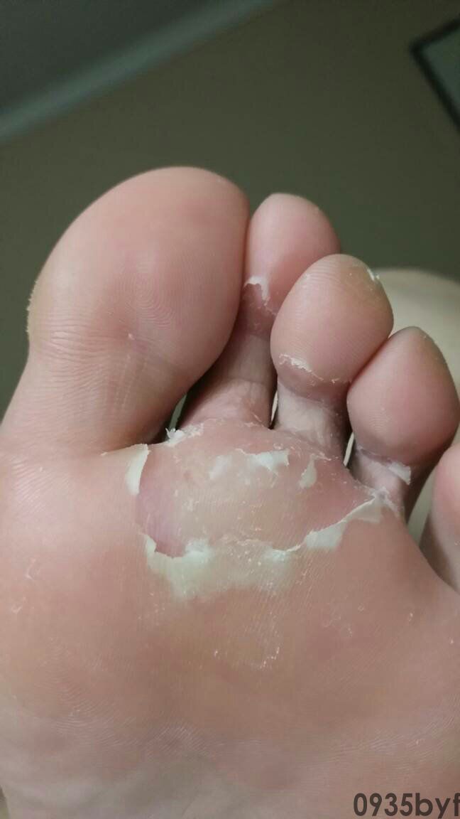 脚脱皮不痒是脚气吗(图1) 脚脱皮不痒是脚气吗