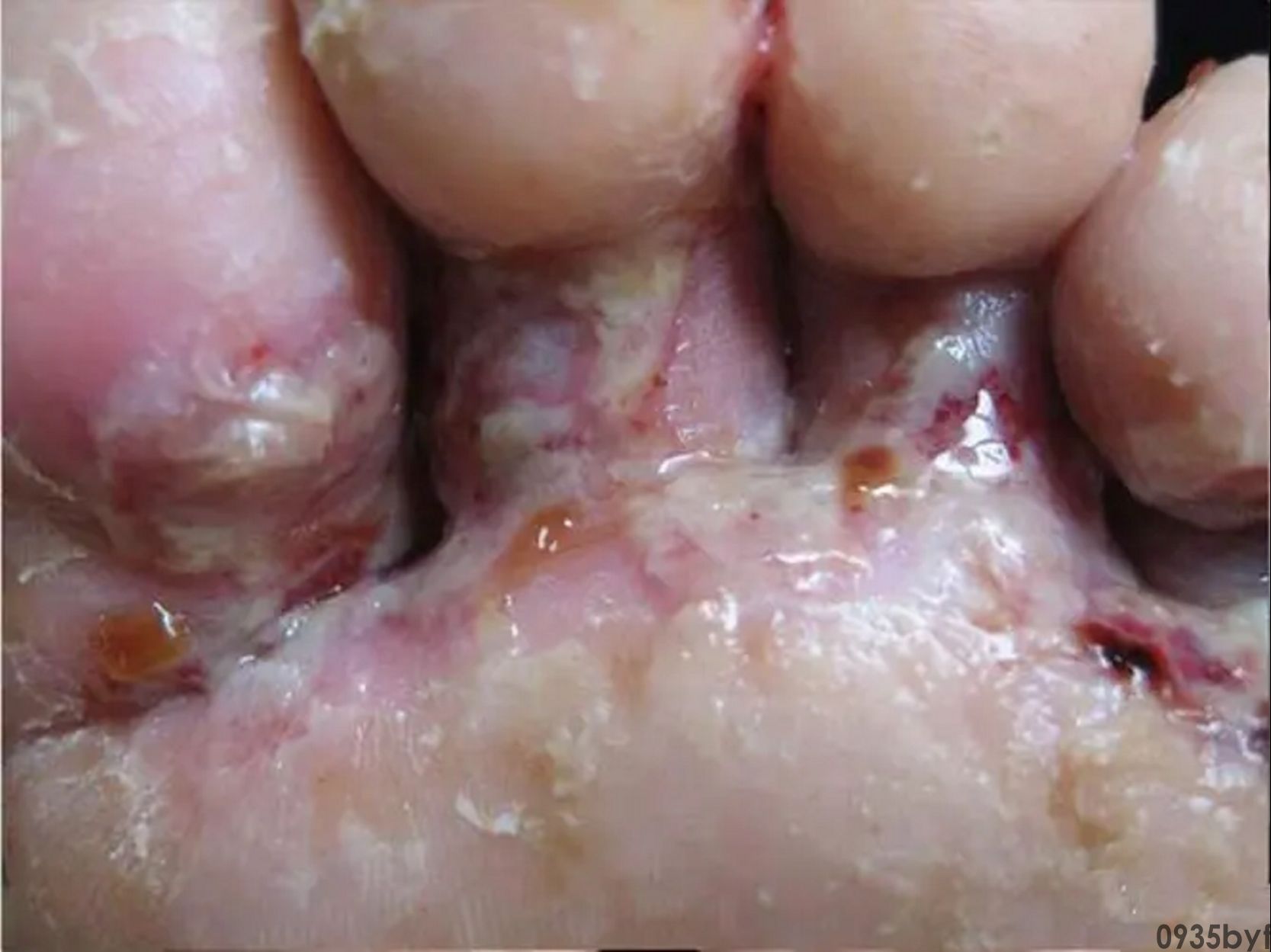 糜烂型脚气是什么病?(图1) 糜烂型脚气是什么病?