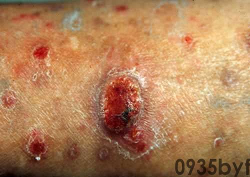 毛发红糠疹性红皮病背部红斑图-有来医生(图1) 毛发红糠疹性红皮病背部红斑图-有来医生