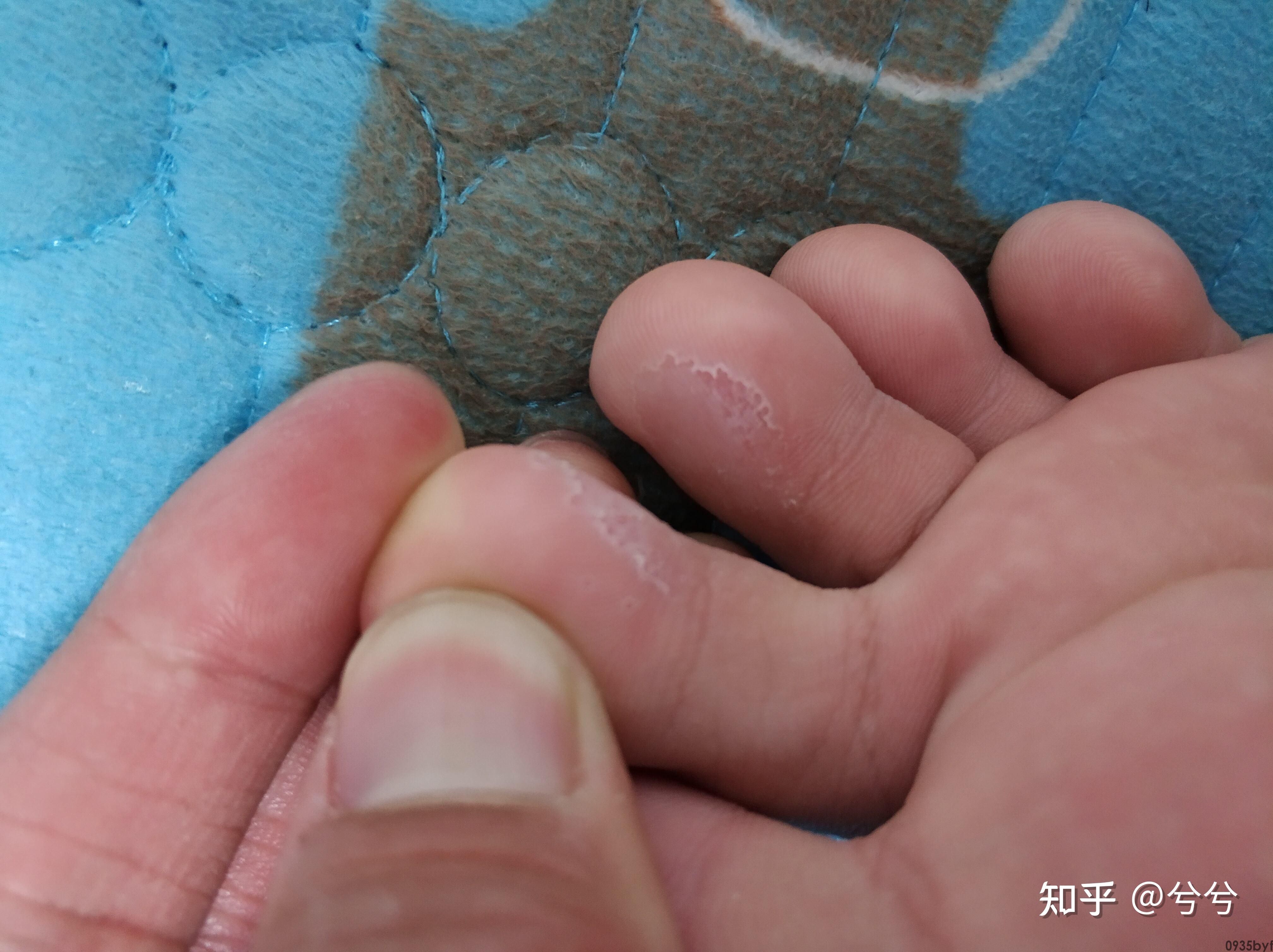 严重糜烂型脚气怎么治疗?要注意什么呢(图1) 严重糜烂型脚气怎么治疗?要注意什么呢