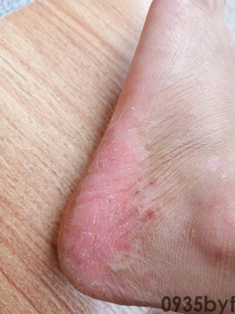 怎么除脚气异味?(图1) 怎么除脚气异味?