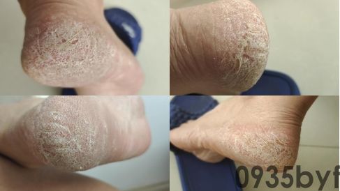 脚气的症状有哪些？都是什么样？(图3)