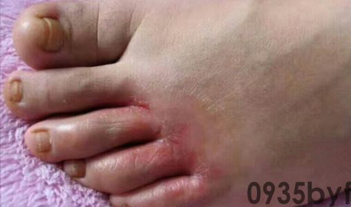 脚气的症状有哪些？都是什么样？(图2)