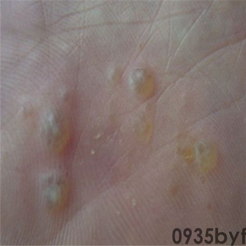 脚气的症状有哪些？都是什么样？(图1)