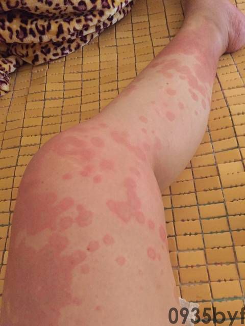 红斑丘疹是什么(图1) 红斑丘疹是什么