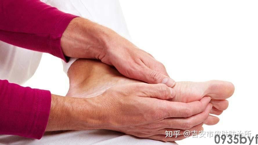 手足癣的治疗误区有哪些(图1) 手足癣的治疗误区有哪些