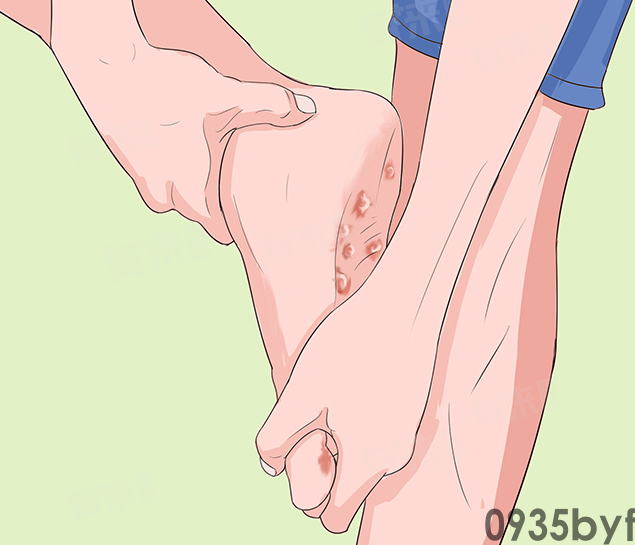 水泡型足癣怎么治愈(图1)