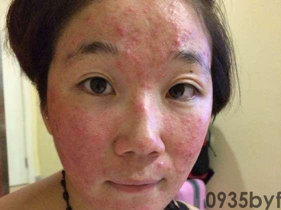 脚气分类-即时问医生_权威医患互动平台