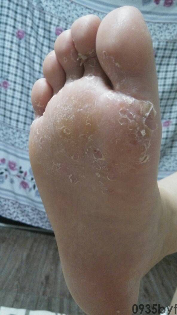 鳞屑型脚气怎样治疗