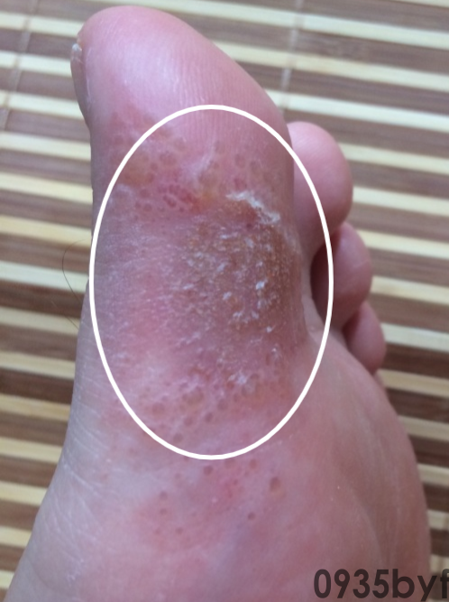 水疱型湿疹怎么回事怎么办(图1) 水疱型湿疹怎么回事怎么办