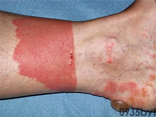 皮革皮炎眼皮处两片红斑图-有来医生(图1) 皮革皮炎眼皮处两片红斑图-有来医生