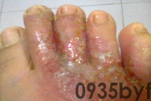 糜烂性脚气解决脚气方法?(图1) 糜烂性脚气解决脚气方法?