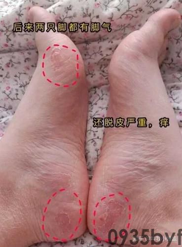 脚气的症状?(图1) 脚气的症状?