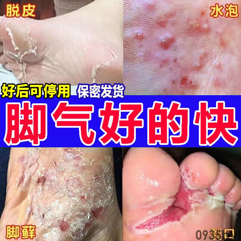糜烂性脚气的治疗方法(图1) 糜烂性脚气的治疗方法