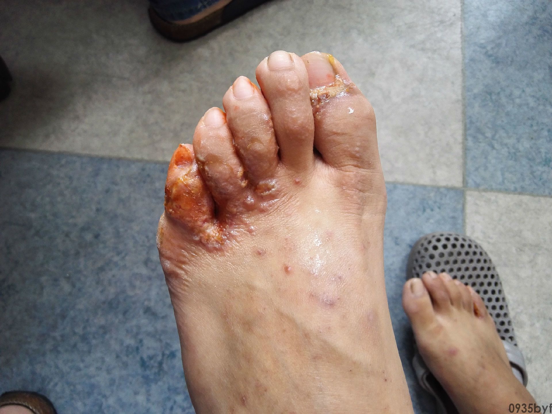 脚气早期症状有哪些(图1) 脚气早期症状有哪些