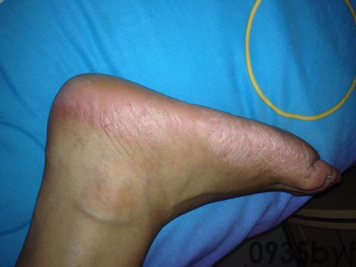 鳞屑角化型足癣用什么药？