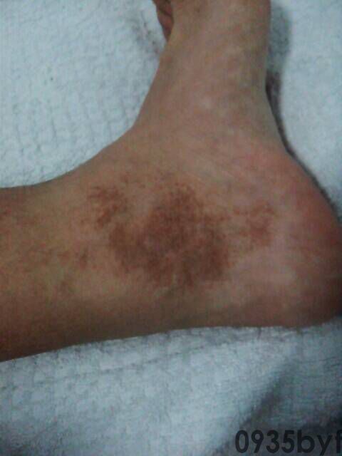 脚上长红斑不痛不痒是什么原因(图1) 脚上长红斑不痛不痒是什么原因