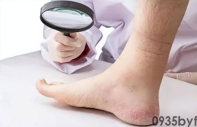 我国脚气患者上亿人这些东西才脚气的“祸根”!(图2) 我国脚气患者上亿人这些东西才脚气的“祸根”!(图2)