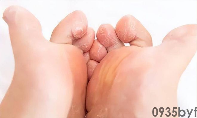 我国脚气患者上亿人这些东西才脚气的“祸根”!(图6) 我国脚气患者上亿人这些东西才脚气的“祸根”!(图6)