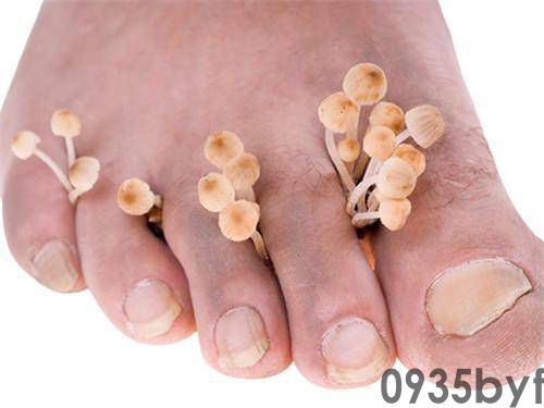 湿性脚气病什么症状表现-名医汇(图1) 湿性脚气病什么症状表现-名医汇