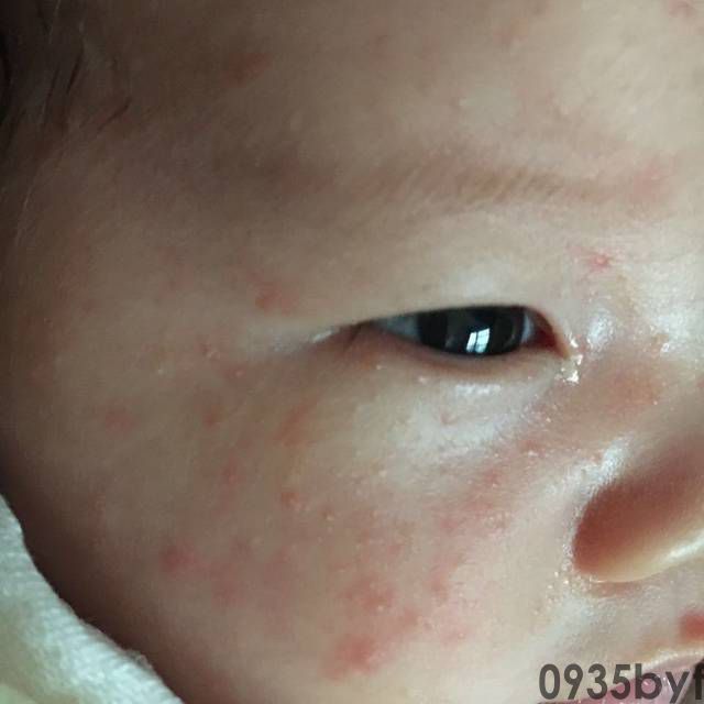 脚上长红色的斑点不疼不痒是怎么回事(图1) 脚上长红色的斑点不疼不痒是怎么回事