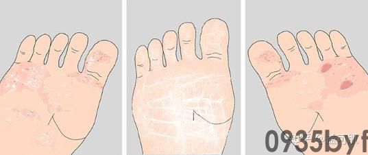 脚气分几种-有来医生