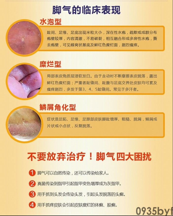 水疱型脚气的病因是什么(图1) 水疱型脚气的病因是什么