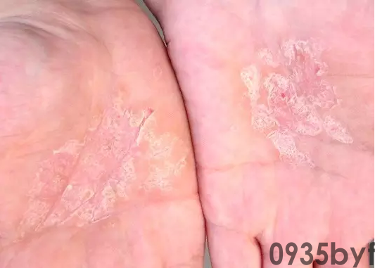 鳞屑角化型脚气如何有效治疗(图1) 鳞屑角化型脚气如何有效治疗