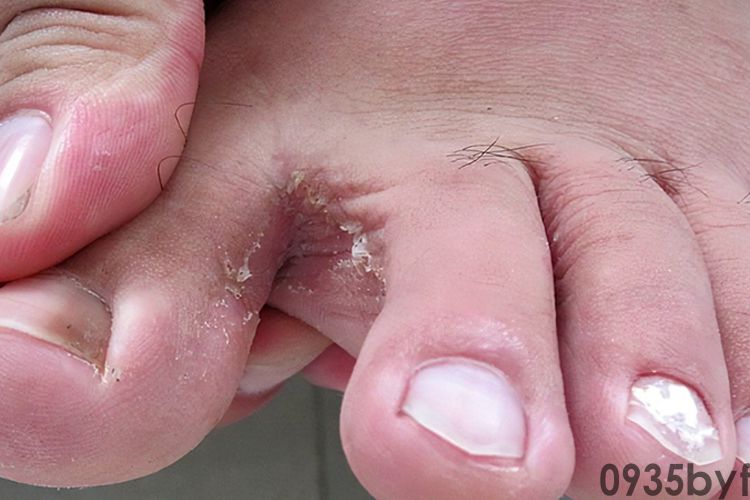 脚易出汗很臭怎么办(图1) 脚易出汗很臭怎么办