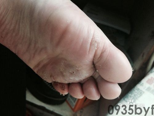 水泡型脚气用什么药?(图1) 水泡型脚气用什么药?