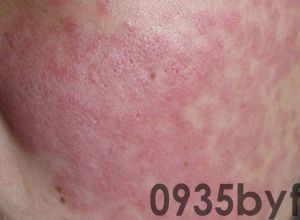 脸上的痘斑痘印怎么去除