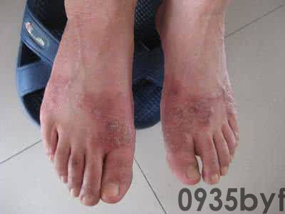 糜烂型脚气的症状论文资料(图1) 糜烂型脚气的症状论文资料