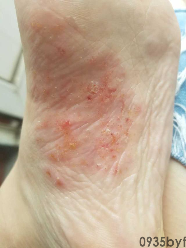 脚气早期症状(图1) 脚气早期症状