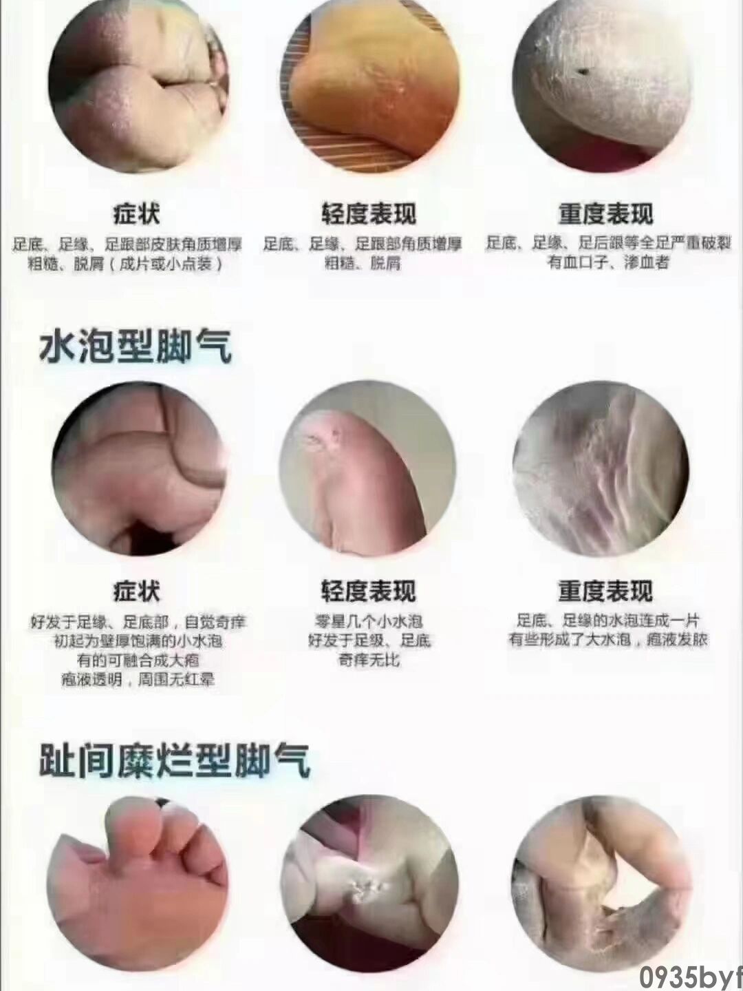宫颈糜烂为什么有臭味(图1) 宫颈糜烂为什么有臭味