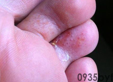 带状疱疹水泡几天能消(图1) 带状疱疹水泡几天能消