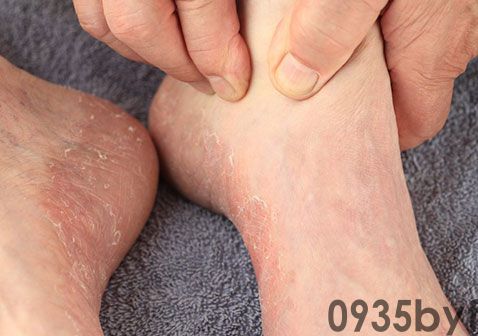 脚气初期有什么症状(图1) 脚气初期有什么症状