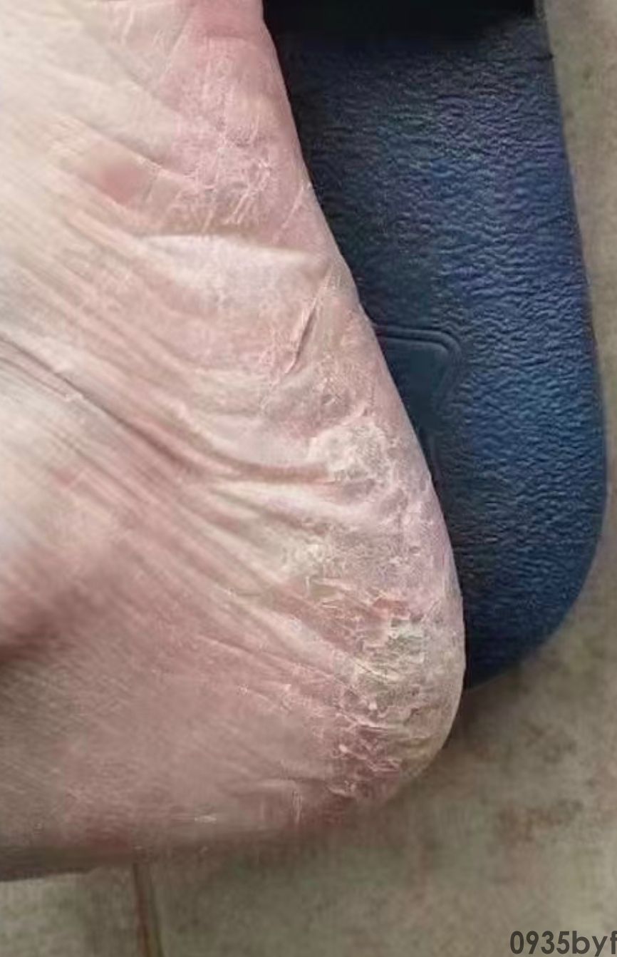 皲裂型足癣用什么药(图1) 皲裂型足癣用什么药