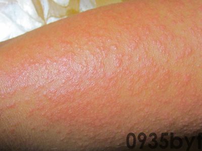 过敏红斑怎么消除(图1) 过敏红斑怎么消除